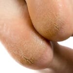 تشققات القدم: الأسباب والعلاج