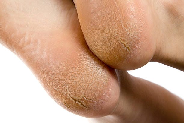 تشققات القدم: الأسباب والعلاج
