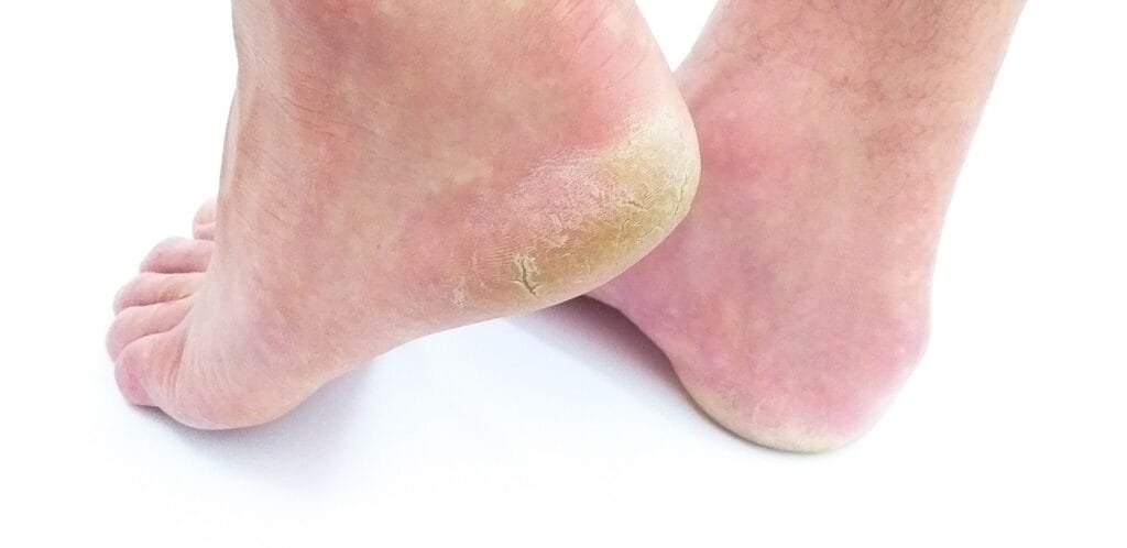 Foot cracks