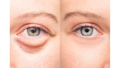 Puffiness under the eyes