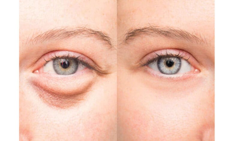Puffiness under the eyes