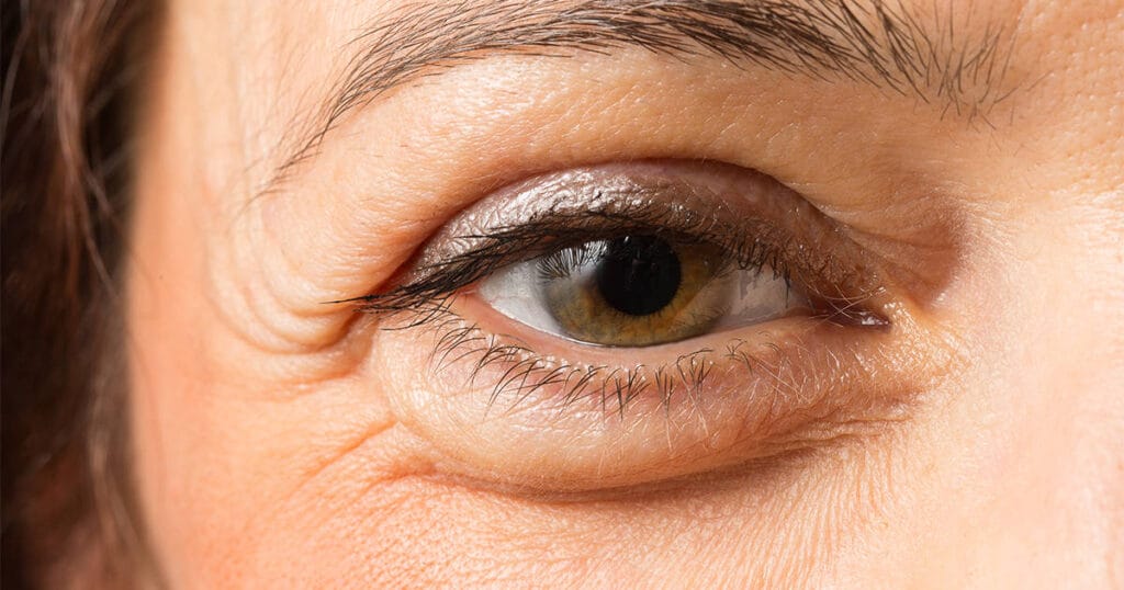 Causes of puffiness under the eyes