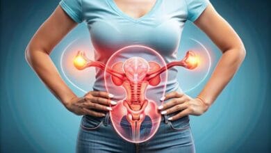 تكيس المبايض