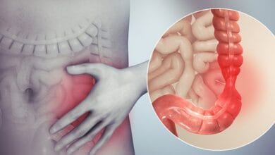 القولون العصبي