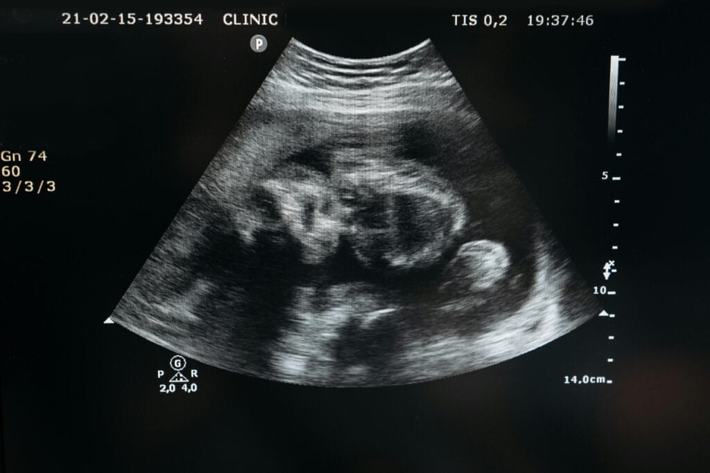 Fetal Movement